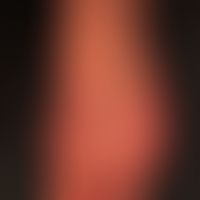 acrocyanosis: typical picture of the red, cold foot in a 42-year-old chain smoker. variable cours...
