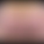 Acrocyanosis: A flat, symptomless, blurredly limited, red-livid spot in the buttocks of a 52-year...