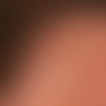 Postmenopausale fibrosierende frontale Alopezie: seit mehreren Jahren kontinuierlich nach hinten ...