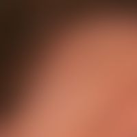 Postmenopausal fibrosing frontal alopecia: For several years now, the hairline has been continuou...