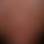 Amiodarone hyperpigmentation: grey-blue hyperpigmentation after long-term application of the prep...