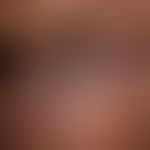 Amiodarone hyperpigmentation: bizarrely configured, flat grey-blue veils reaching far beyond the ...