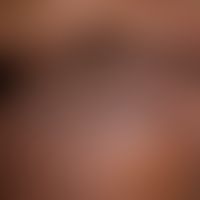 Amiodarone hyperpigmentation: bizarrely configured, flat grey-blue veils reaching far beyond the ...