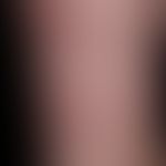 Systemische Amyloidose: persistierende Purpura (s. Legende Abb. zuvor).
