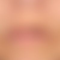 Argyrie: lokalisierte Argyrie der Lippenregion und der Mundschleimhaut.
