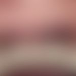 Argrie der Gingiva: umschriebene, scharf abgegrenzte blau-schwarze, symptomlose&nbsp;Flecken der ...
