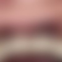 Argrie der Gingiva: umschriebene, scharf abgegrenzte blau-schwarze, symptomlose&nbsp;Flecken der ...