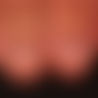 Idiopathic brachyonychia of the thumbnails. wide spoon-like nails with numerous longitudinal groo...