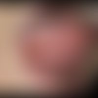 For 12 days persistent, approx. 0.4 x 0.7 cm large, aphthous, whitish, highly painful ulcer on th...