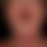 Severe chronic glandular cheilitis under vemurafenib therapy.
