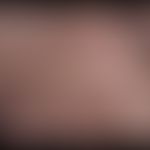 Dyshidrotische Dermatitis: innerhalb von 2 Tagen auftretende großblasiges dyshidrotische Dermatit...