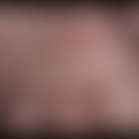 Dyshidrotische Dermatitis: innerhalb von 2 Tagen auftretende großblasiges dyshidrotische Dermatit...