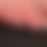 Chilblain Lupus - temperaturabhängige Rötung, Schwellung und Schmerzhaftigkeit mehrere Zehen.
