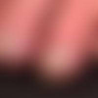 Chilblain Lupus - Detailaufnahme

