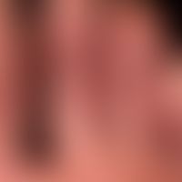 Chilblain Lupus: flächige, schmerzhafte Rötungen der Plantarseite mehrerer Zehen.
