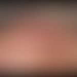 Chondrodermatitis nodularis chronica helicis. 68 Jahre alter Patient mit seit drei Monaten besteh...