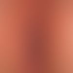 Condylomata acuminata. Befund bein einem Kleinkind mit multiplen kleinen wenig symptomatischen Pa...