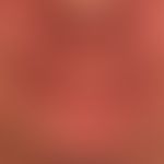 Dematitis periorale. granulomatous type of perioral dermatitis: theclinical picture was preceded ...