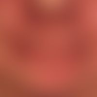 Dematitis periorale. granulomatous type of perioral dermatitis: theclinical picture was preceded ...