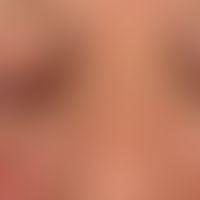 Periorbital dermatitis: here the counterpart to perioral dermatitis.
