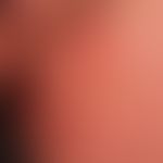 Tinea corporis mit randbetonten, zentral abgeheilten, schuppenden, wenig symptomatischen&nbsp;Pla...