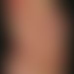 Dermatomyositis adult: variable and inconsistent, multiple large blurred, red to red-violet eryth...