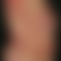 Dermatomyositis adulte: wechselhafte und inkonstante, multiple großflächige unscharf begrenzte, r...
