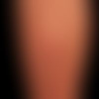 Dermatosis acute febrile: large red, succulent, pressure-dolent, infiltrated, solitary and partly...