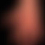 Dupuytren's contracture: Severity III: Nodular induration of the palm with retraction of the skin...