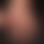 Dermatomyositis. 72 year old patient with dermatomyositis known for 1 year. striped red, scaly pa...