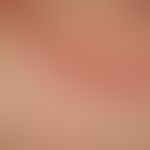 Erythema gyratum repens: Detail of the rim area of the ring structure. clearly palpable (like a w...