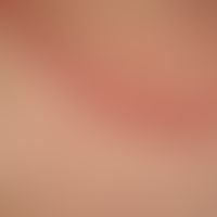 Erythema gyratum repens: Detail of the rim area of the ring structure. clearly palpable (like a w...