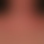 Dermatitis, seborrhoeic: 62-year-old patient with a negative family history of psoriasis. recurre...