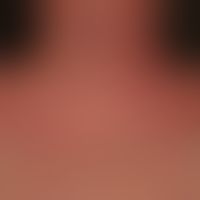 Dermatitis, seborrhoeic: 62-year-old patient with a negative family history of psoriasis. recurre...