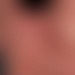 Airborne Contact Dermatitis:&nbsp;chronisches (>6 Wochen) flächenhaftes, enorm juckendes und b...