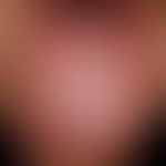 exfoliatio areata linguae. numerous, confluent, roundish "plaque free" areas. distinct burning se...