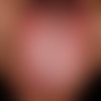 exfoliatio areata linguae. numerous, confluent, roundish "plaque free" areas. distinct burning se...