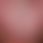 Exfoliatio areata linguae: Detailed picture: In the middle part of the tongue normal tension coat...