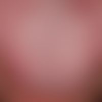 Exfoliatio areata linguae: Detailed picture: In the middle part of the tongue normal tension coat...