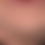 Elastose: Vergröbertes Hautrelief mit ausgeprägter Makro-Faltenbildung. Die Haut ist schlaff, fal...