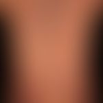 Epidermolysis bullosa dystrophica Hallopeau-Siemens: Multiple, generalized (trunk, extremities, p...
