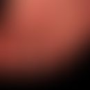 Secondary atrophy in epidermolysis bullosa hereditaria, extensive atrophy of the skin with anonyc...