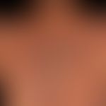 Atrophie der Haut bei Epidermolysis bullosa dystrophica 
