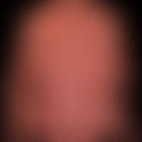Pustulose, akute generalisierte exanthematische.&nbsp; Nach Medikamenteneinnahme (Vemurafenib) ak...