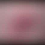 Furunkel. 38 Jahre alter Patient mit rezidivierender Furunkelbildung. 2,5 x 2,0 cm großer, sponta...