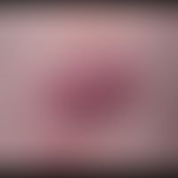 Furunkel. 38 Jahre alter Patient mit rezidivierender Furunkelbildung. 2,5 x 2,0 cm großer, sponta...