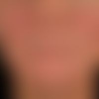 Rosacea erythematosa: Charakteristische flächige Rötung beider Wagenpartien.

