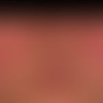 DD: Rosacea erythematosa (vorliegend ein systemischer lupus erythematodes): schmetterlingsartige,...
