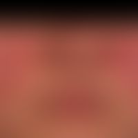 DD: Rosacea erythematosa (vorliegend ein systemischer lupus erythematodes): schmetterlingsartige,...