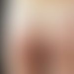 Zerkariendermatitis. Disseminierte, urtikarielle, stark juckende Papeln und Plaques im Bereich de...
